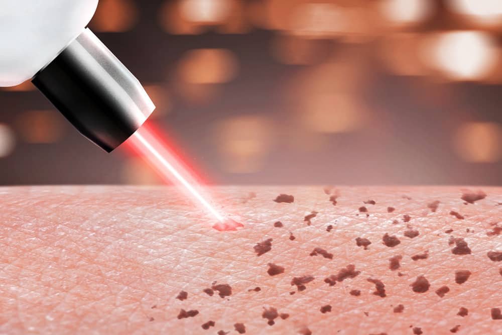 CMG-Blog-Laser-Melasma-Rosacea-2
